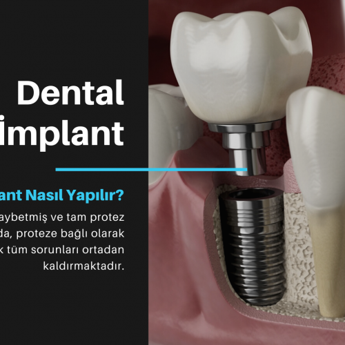 Dental İmplant