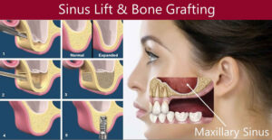 ankara sinus lifting