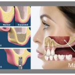 ankara-sinus-lifting