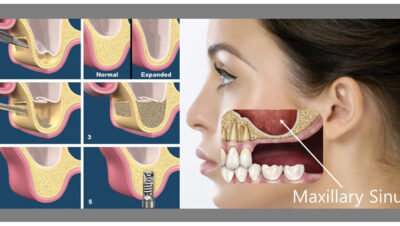 ankara-sinus-lifting