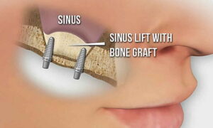 sinus lift